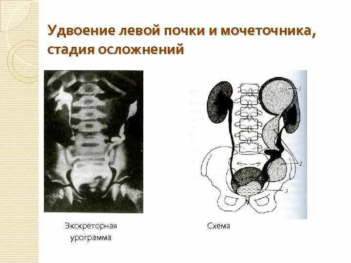 Удвоение мочеточника. Удвоение полостной системы левой почки. Удвоение почки удвоение мочеточника. Неполное удвоение мочеточника. Неполное удвоение почки.