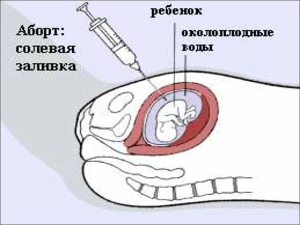 Вакуумное прерывание беременности после. Солевой амниоцентез аборт. Интраамниальное Введение гипертонического раствора. Схема хирургического аборта.