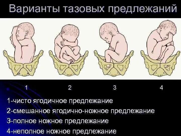 Смешанное ягодичное предлежание