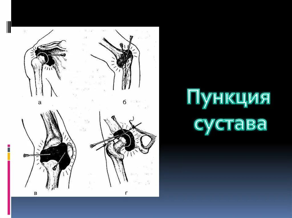Пункция тазобедренного сустава техника выполнения. Пункция коленного сустава топографическая анатомия. Верхний заворот коленного сустава пункция. Пункция плюсневого сустава. Пункция тазобедренного сустава техника.
