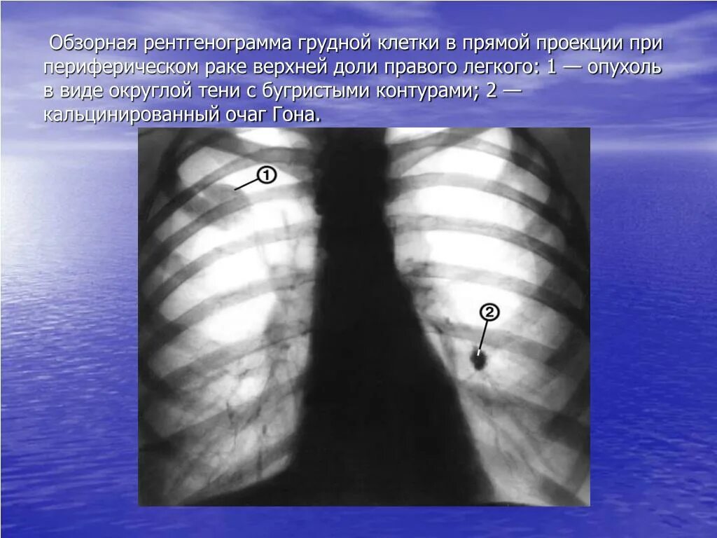 Периферическое образование левого легкого. Очаг уплотнения s6 правого легкого. Очаг гона в верхней доле левого легкого. Очаг гона s3 левого легкого..