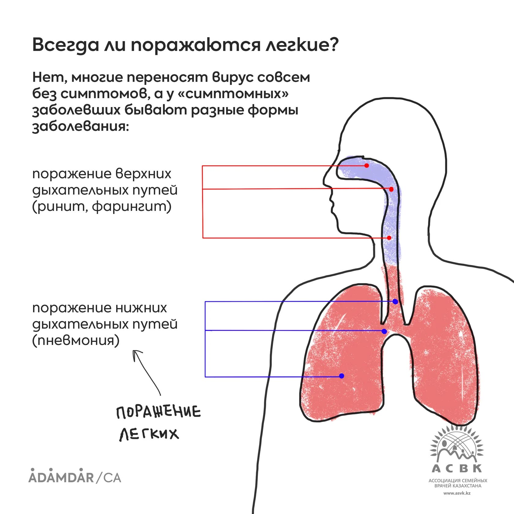 Процент поражения легких. Степени поражения легких при коронавирусе по кт. На сколько поражены легкие. Туберкулез бронха рентген. На сколько поражены легкие.