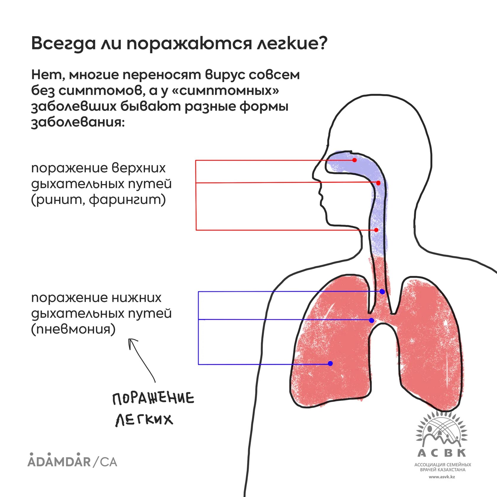 Лёгкие поражённые коронавирусом. Симптомы поражения легких при коронавирусе. Поражение лёгких при коронавирусе. Ковид восстановление легких