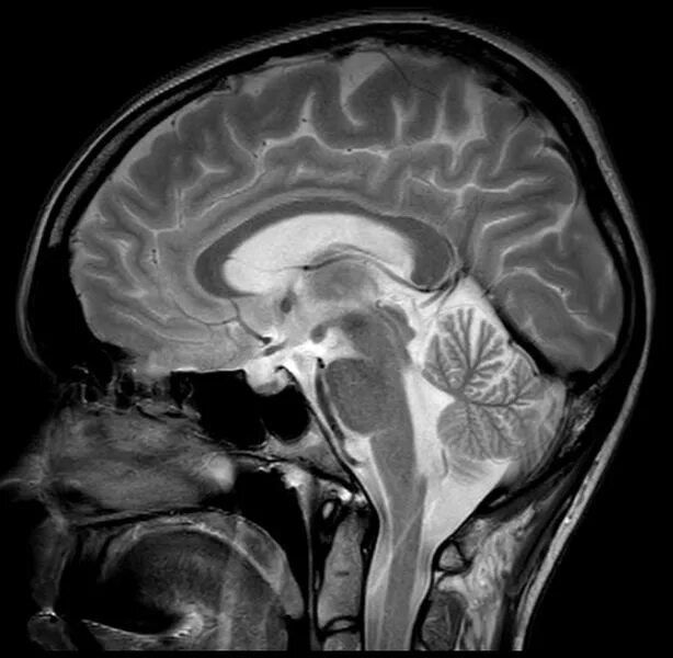 Патологии на мрт. Мрт мозга Сагиттальный срез норма. Мрт головного мозга Сагиттальный срез. Мрт головного мозга мозжечок. Кт головного мозга в сагиттальной проекции.