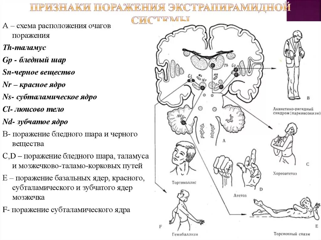 Поражение экстрапирамидной системы. Экстрапирамидная система синдромы поражения. Симптомы поражения мозжечка неврология. 1. Экстрапирамидная система. Анатомия, физиология, синдромы поражения.. Экстрапирамидная система неврология поражение.