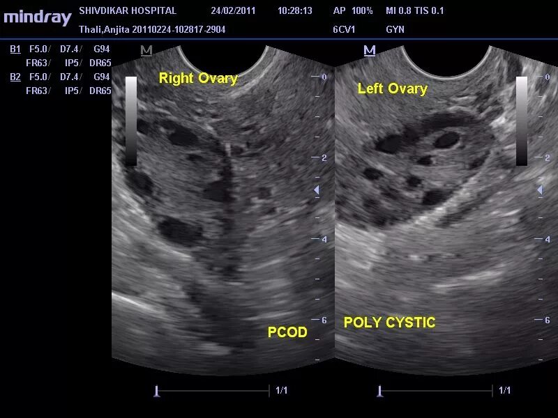 УЗИ мультифолликулярных яичников. Синдром поликистозных яичников УЗИ. Мультифолликулярные яичники на УЗИ. Поликистоз яичников УЗИ критерии. Мфя в гинекологии что