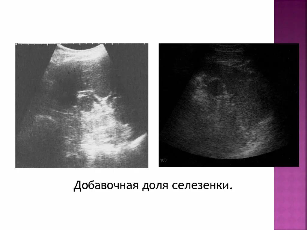 Добавочная долька селезенки на УЗИ. Добавочная долька селезенки на кт. Дополнительная долька селезенки что это такое у взрослого.