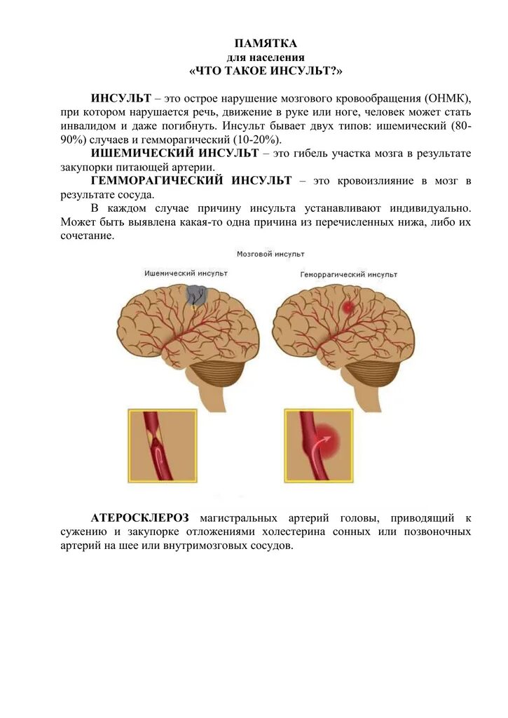 Инсульт статья. Инсульт памятка для населения. Памятка при инсульте. Ишемический инсульт памятка. Мозг инсульт памятка.