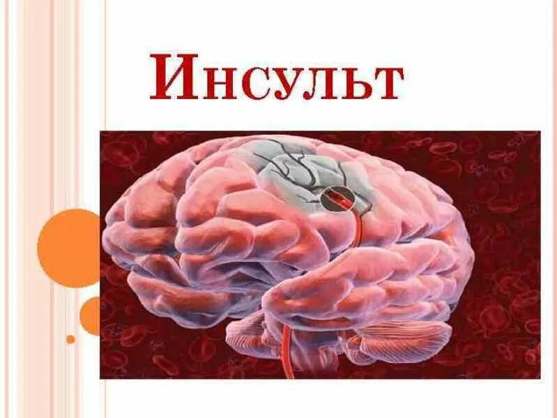 Инсульт картина. Инсульт картинки. Презентация по теме инсульт. Инсульт рисунок.