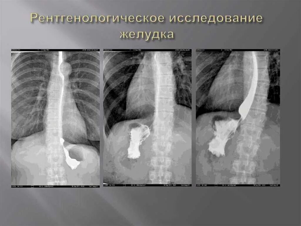 Пищевода с барием. Методика исследования пищевода рентген. Рентгенологический метод исследования желудка. Рентгеноконтрастные методы исследования желудка и пищевода. Рентгенологические исследования пищевода с бариевой взвесью.