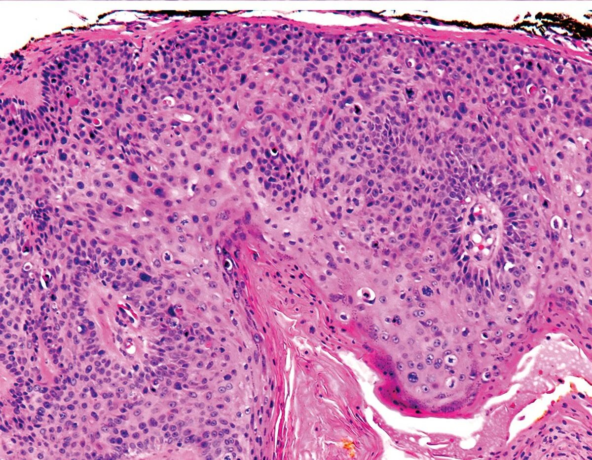 Плоскоклеточными опухолями. Плоскоклеточная карцинома кожи гистология. Плоскоклеточная карцинома in situ. Плоскоклеточная карцинома squamous Cell carcinoma.