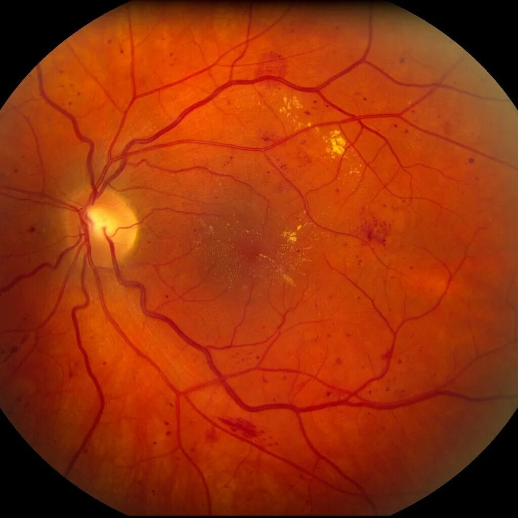 Диабетическая ретинопатия глазное дно. Ангиопатия и ретинопатия сетчатки. Гипертоническая ретинопатия сетчатки. Пролиферативная диабетическая ретинопатия.