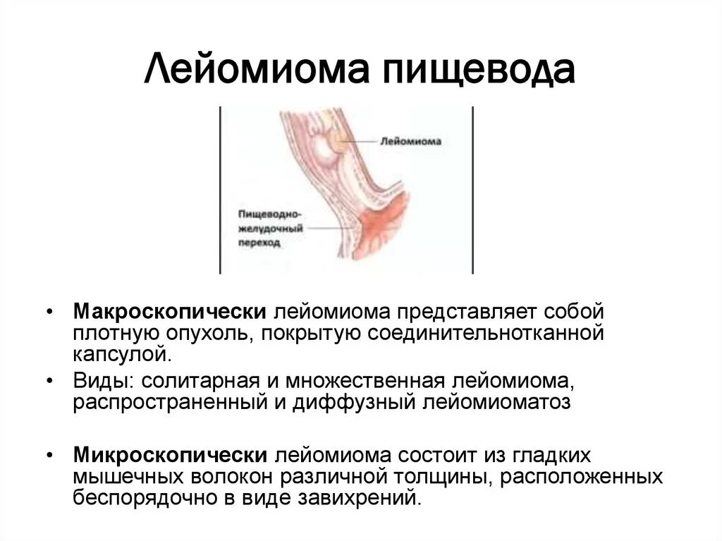 Ком в пищеводе причины. Лейомиома желудка гистология. Рентген лейомиомы пищевода. Лейомиома средней трети пищевода схема. Форма опухоли пищевода.