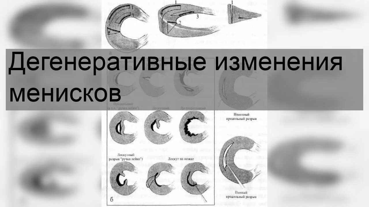 Дегенеративные изменения заднего рога медиального мениска 2