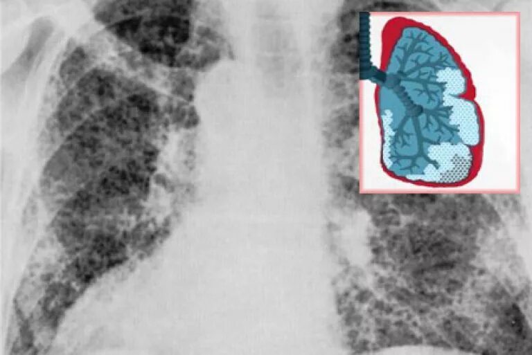 Фиброз легких врач. Легочный фиброз на рентгене. Апикальный пневмофиброз. Периспондилофитарный фиброз. Фиброзные изменения в легких рентген.