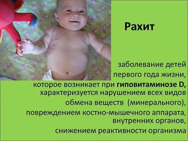 Симптомы рахита у грудничка в 6 месяцев. Рахит у младенца 1 месяц. Симптомы рахита у грудничка в 8 месяцев. Рахит ребенку 5