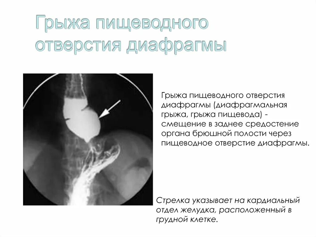 Грыжа пищеводного отверстия симптомы лечение. Скользящая грыжа пищеводного отверстия рентген. Параэзофагеальная грыжа диафрагмы. Эзофагеальная грыжа диафрагмы клиника. Аксиальная грыжа пищевода рентген.