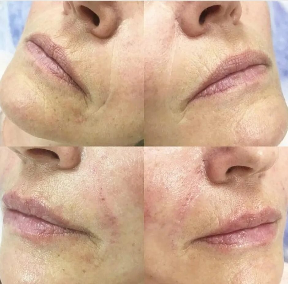 Носогубка гиалуроновая кислота. Контурная пластика носогубка. Какие филлеры рассасываются. Какие филлеры рассасываются. Ювидерм волюма в скулы.