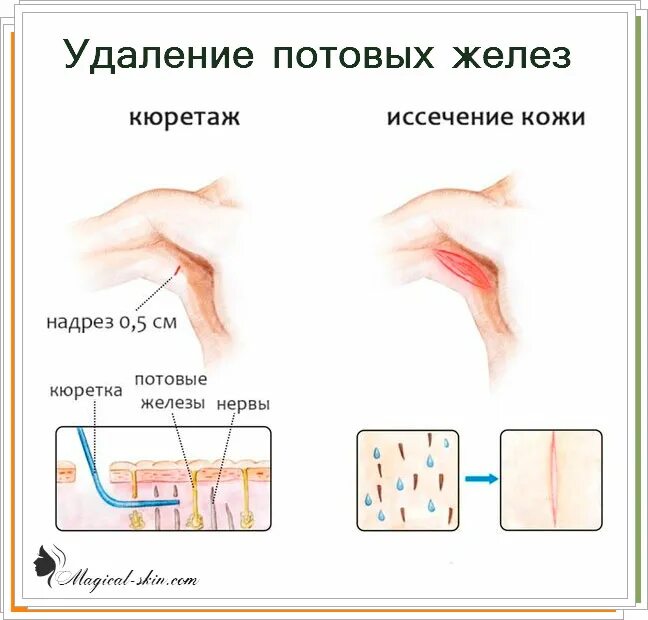 Удалить потовую железу