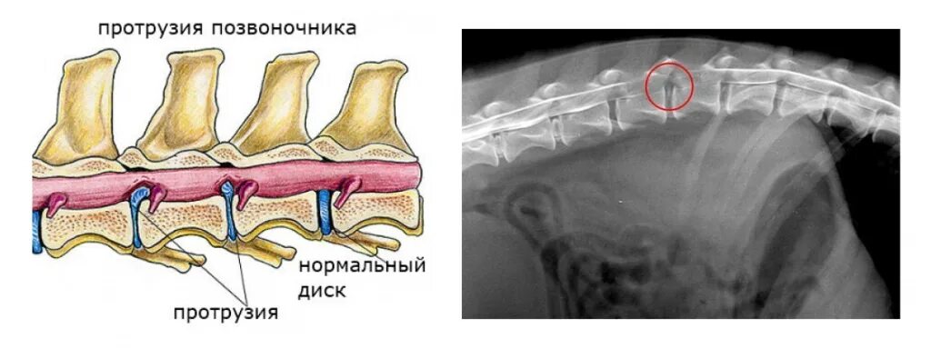 Протрузия экструзия грыжа. Протрузии l4 l5. Протрузия диска позвоночника. Протрузия l5 l6. Экструзия дисков шейного отдела позвоночника