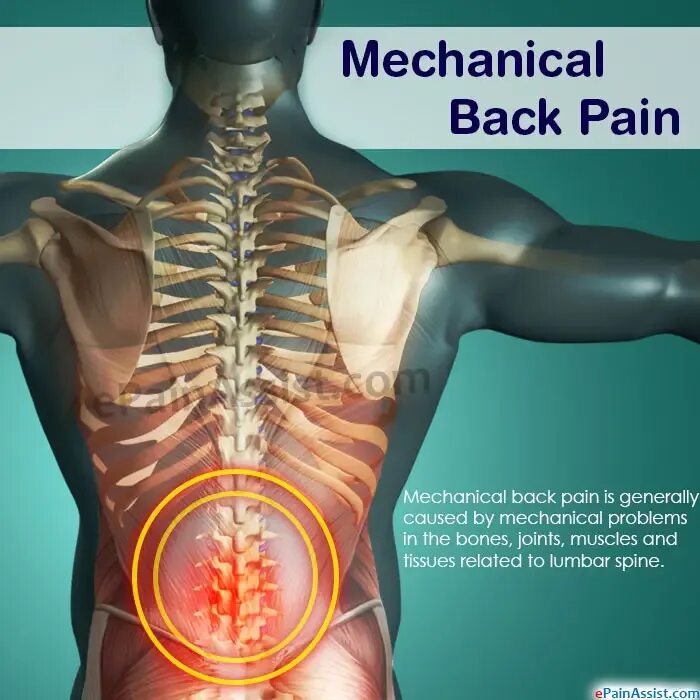 Поясница средство. Back Pain индийский. Pain in muscles and Joints. Low Mechanical back Pain/strain. Pain in the Lumbar.