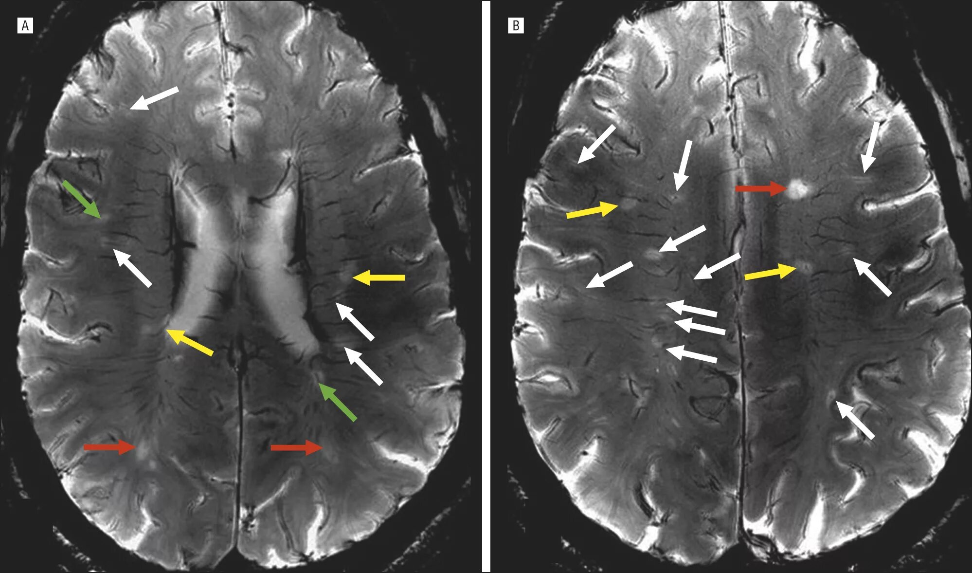 Склероз мозга. Очаги рассеянного склероза на мрт. Очаги при рассеянном склерозе мрт. Мрт при рассеянном склерозе с контрастом. Рассеянный склероз на мрт без контраста.