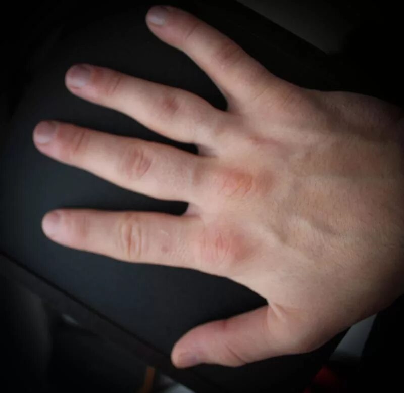 после перелома безымянного пальца