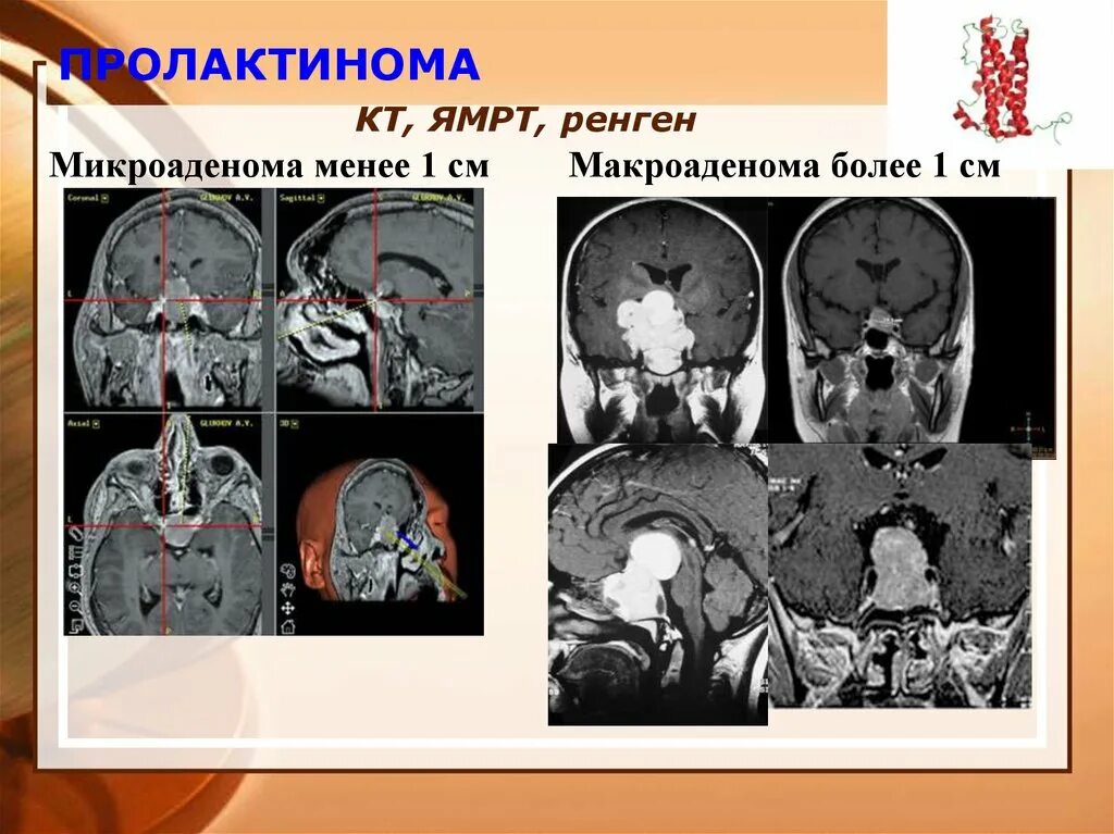 Пролактин микроаденома. Микроаденома гипофиза кт. Краниофарингиома гипофиза мрт. Аденома гипофиза снимок. Микроаденома гипофиза мрт.