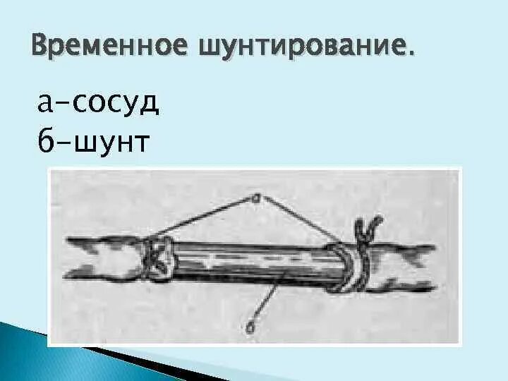 Шунт сосудов. Временное шунтирование сосуда. Временное шунтирование сосуда при кровотечении. Временное шунтирование магистрального сосуда.