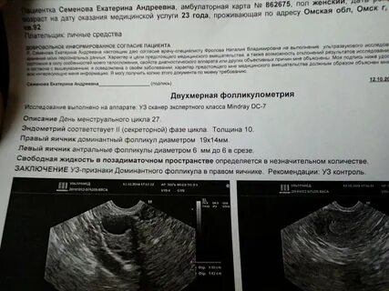 1 доминантный фолликул