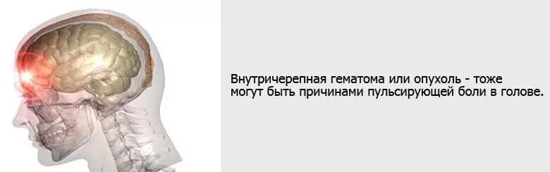 Пульсирует затылок причины. Пульсирующая боль в голове. Головная боль локализация. Пульсирующая боль мозг. Головная боль с пульсацией.