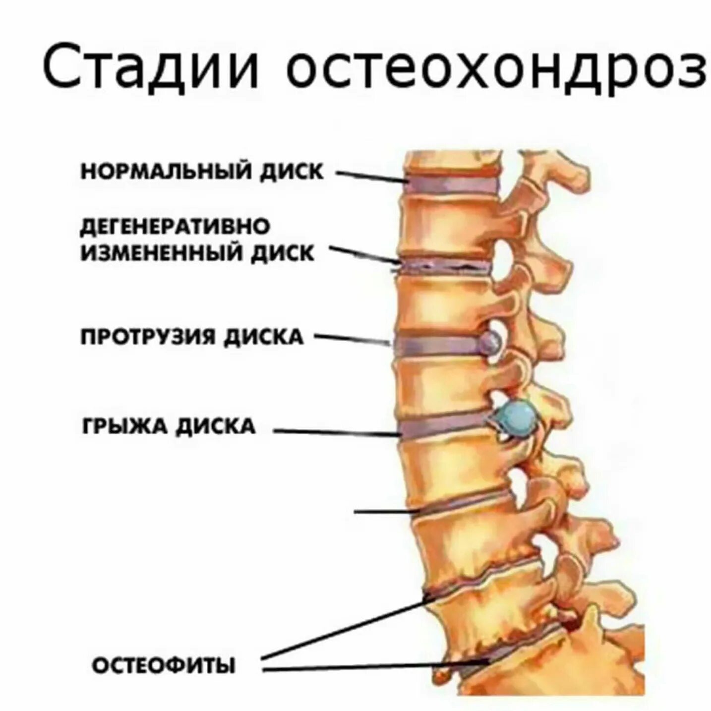 Межпозвонковый остеохондроз (поражение до 3 межпозвонковых дисков). Хондроз шейного отдела у женщин. Задние краевые остеофиты тел l2-s1. Остеохондроз межпозвонковых дисков пояснично крестцового отдела. Остеохондроз схема.