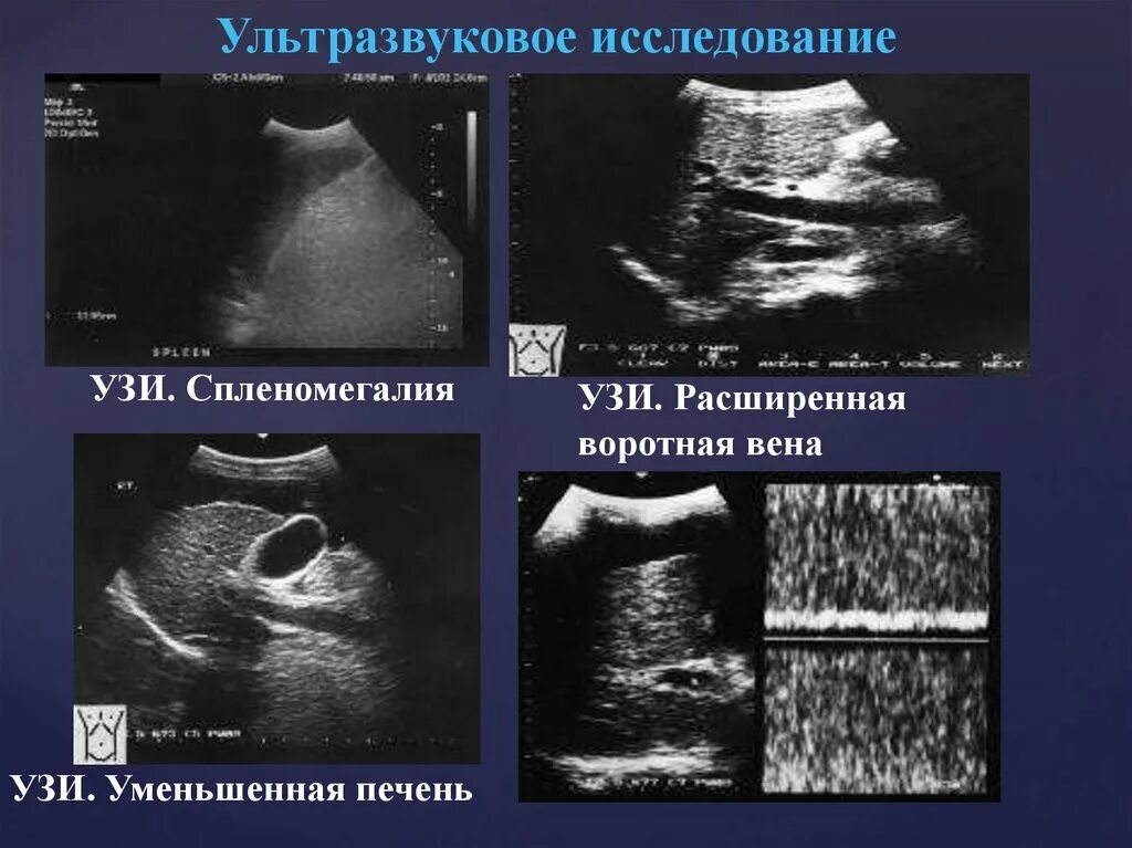 Расширенные вены печени. Расширение воротной вены на УЗИ. Синдром портальной гипертензии у детей УЗИ. Тромбоз воротной вены на УЗИ. Портальная гипертензия у детей на УЗИ.