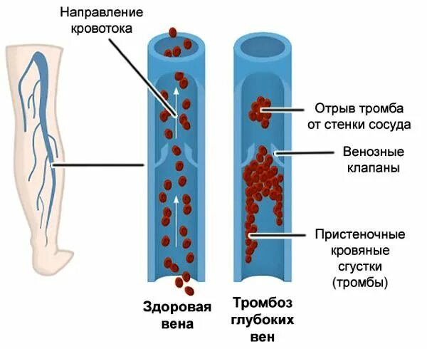 Удаление тромба лазером. Отрыв тромба в артерии.
