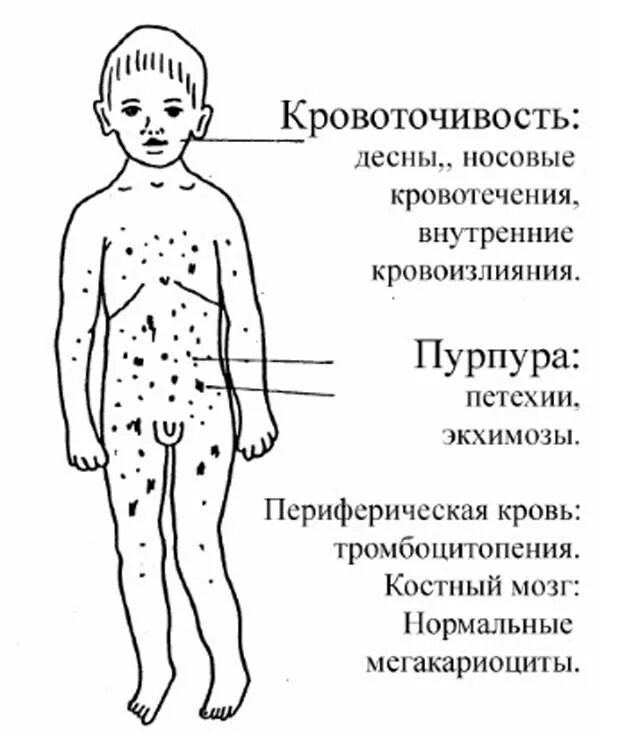 Тромбоцитопения синдром