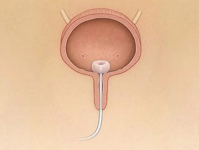 Катетер не идет моча. Цистостома мочевого пузыря. Цистостома мочевого пузыря катетер. Катетеризация мочеточника катетер.