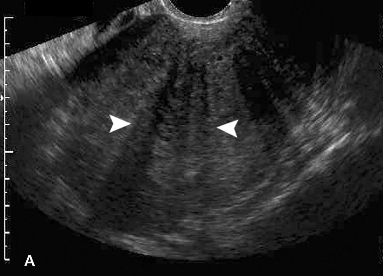 Признаки эндометриоза на узи что это. Узловая форма аденомиоза матки на УЗИ.