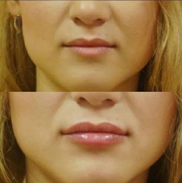 Контур губ гиалуроновой кислотой до и после. Уколы для губ увеличивающий объем. Коррекция контура губ без увеличения объема. Гиалуроновая кислота по контуру губ.