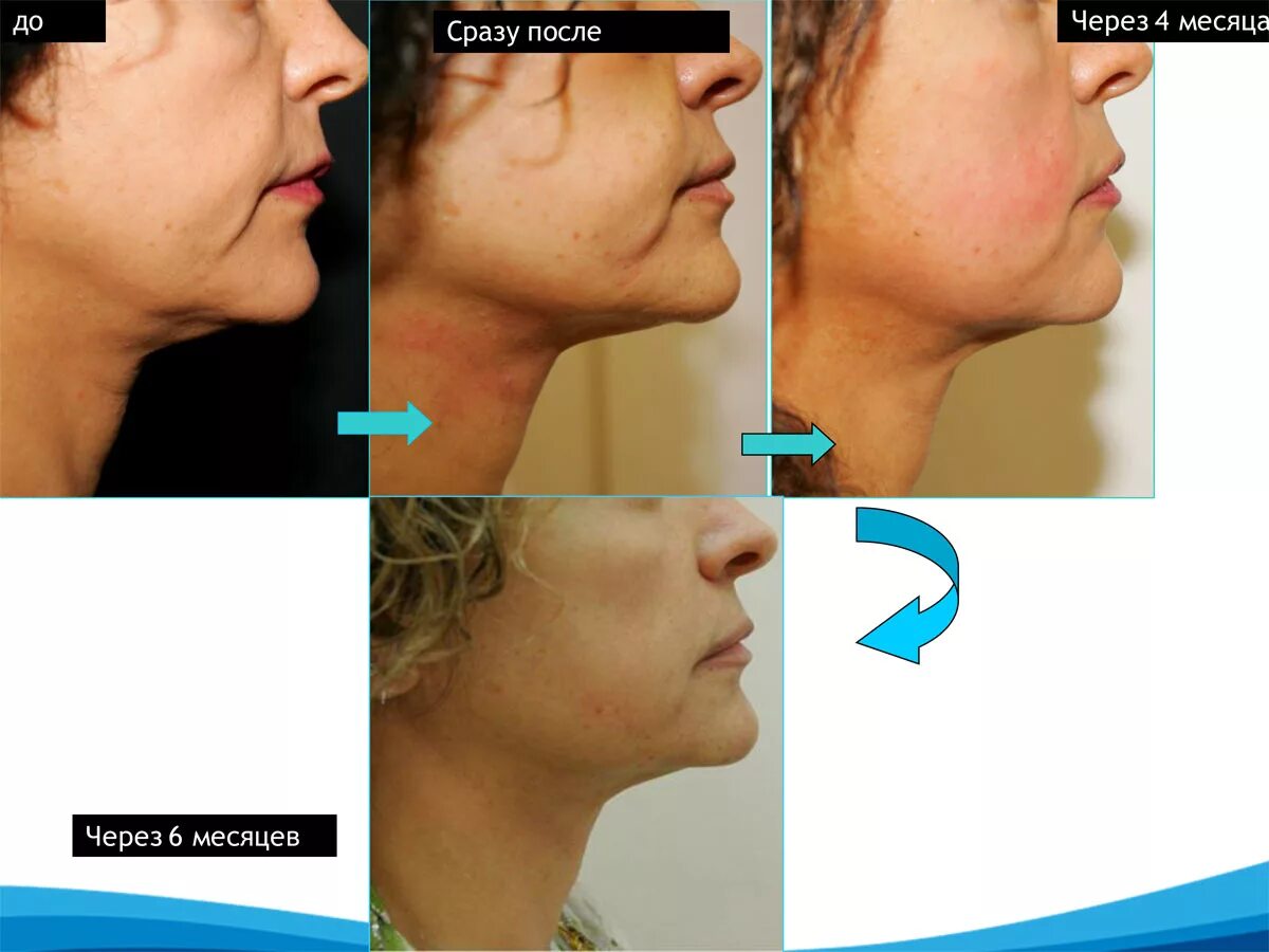 Ультраформер отзывы фото. Ультраформер до и после. Smas-лифтинг ультраформер iii. Ультраформер смас аппарат. Ультраформер лифтинг.