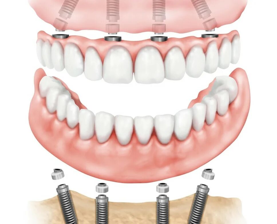 Имплантация зубов по технологии «all on 4». Имплантация челюсти на 4 имплантах. Протез нижней челюсти на 4 имплантах.