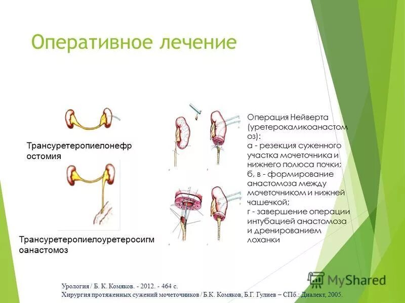 гидронефроз врожденный макропрепарат. врожденный гидронефроз операция. операция при сужении мочеточника. гидронефроз уретерогидронефроз урология. резекция и шов мочеточника.