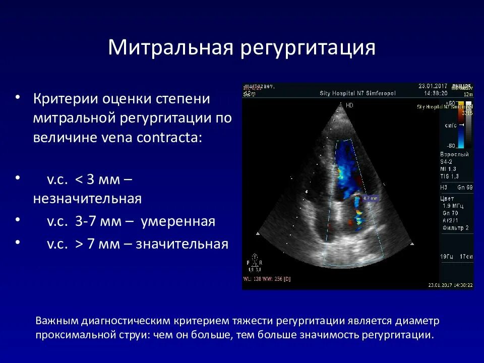 Митральная регургитация ЭХОКГ. Митральный клапан степень регургитации норма. Степени регургитации митрального клапана по УЗИ. Допплер ЭХОКГ при митральной недостаточности.