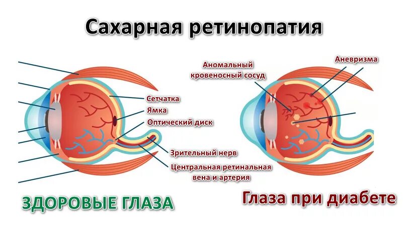 Катаракта глаза при сахарном диабете. Ретинопатия при сахарном диабете 2 типа. диабетическая ретинопатия глаз. капли при диабетическая ретинопатия. ретинопатия глаза при сахарном диабете 2 типа.