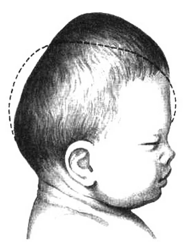 Долихоцефалическая форма черепа новорожденного. Брахицефалическая форма головы новорожденного. Долихоцефалическая форма головы у младенца. Долихоцефалическая форма головы Акушерство. Переднеголовное предлежание
