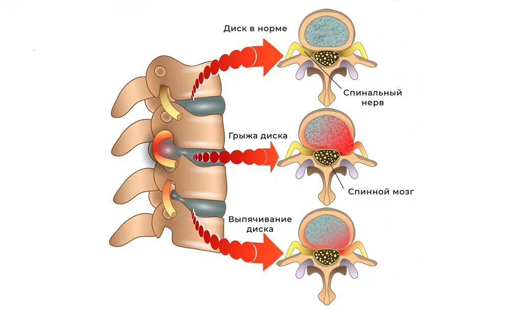 Грыжа поясничного отдела лечение у мужчин симптомы. Грыжи дисков в грудном отделе позвоночника. Грыжа межпозвоночного диска грудного отдела. Межпозвонковая грыжа симптомы. Грыжа грудного отдела позвоночника симптомы.