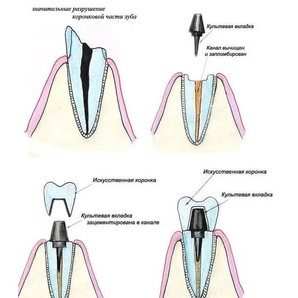Какую функцию выполняет коронка зуба. Культевая вкладка и коронка. Культевая вкладка со штифтом. Штифтовая культевая вкладка и коронка. Как устанавливается вкладка под коронку.