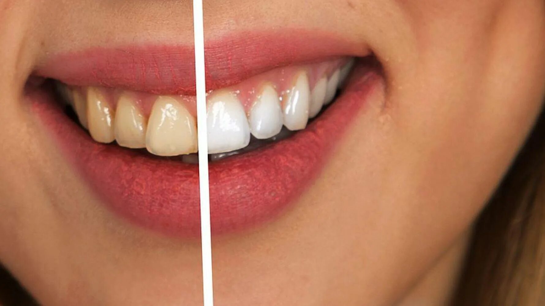 Отбеливание зубной эмали. Отбеливание темных зубов. Натуральные зубы. Отбеливается эмаль зубов.