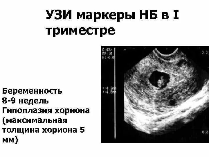 Отслойка хориона на ранних сроках