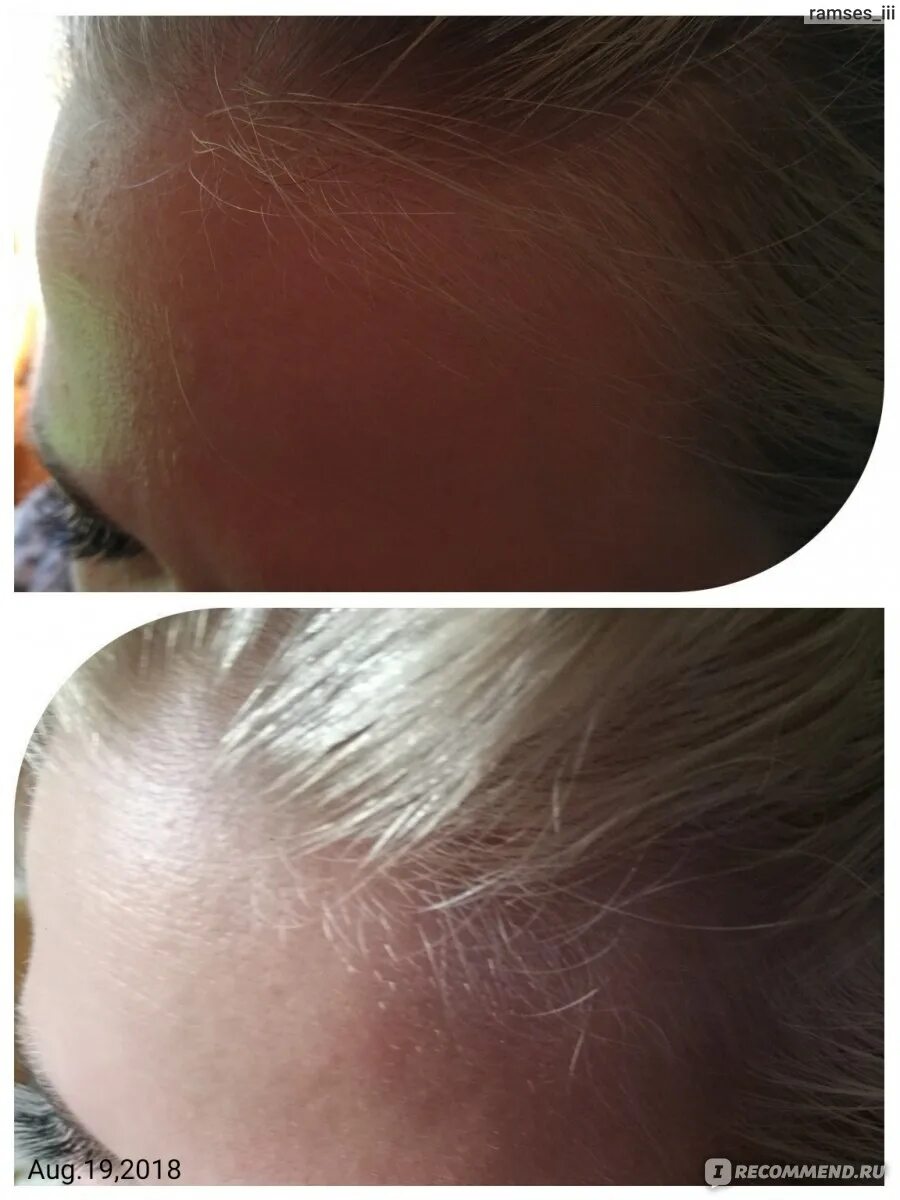 Как разбудить луковицу головы. Разбудить спящие луковицы волос. Как пробудить спящие луковицы. Как пробудить спящие луковицы волос на голове. Как пробудить спящие луковицы волос на голове у мужчин.