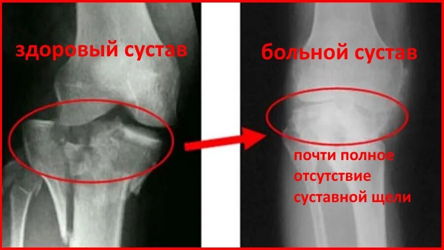 Гонартроз 2 степени коленного сустава рентген. Рентген при гонартрозе 2 степени. Деформирующий гонартроз рентген.